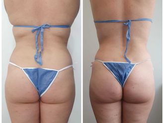 Mesoterapia antes y después - 793409