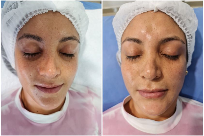 Plasma rico en plaquetas antes y después - 793410