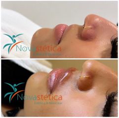 Aumento de labios - Novastética