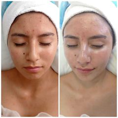 Rejuvenecimiento facial - Novastética