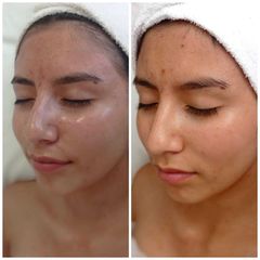 Rejuvenecimiento facial - Novastética