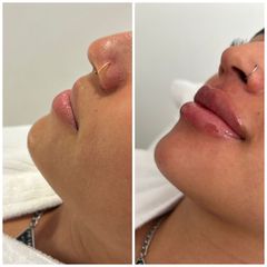 Aumento de labios - Novastética