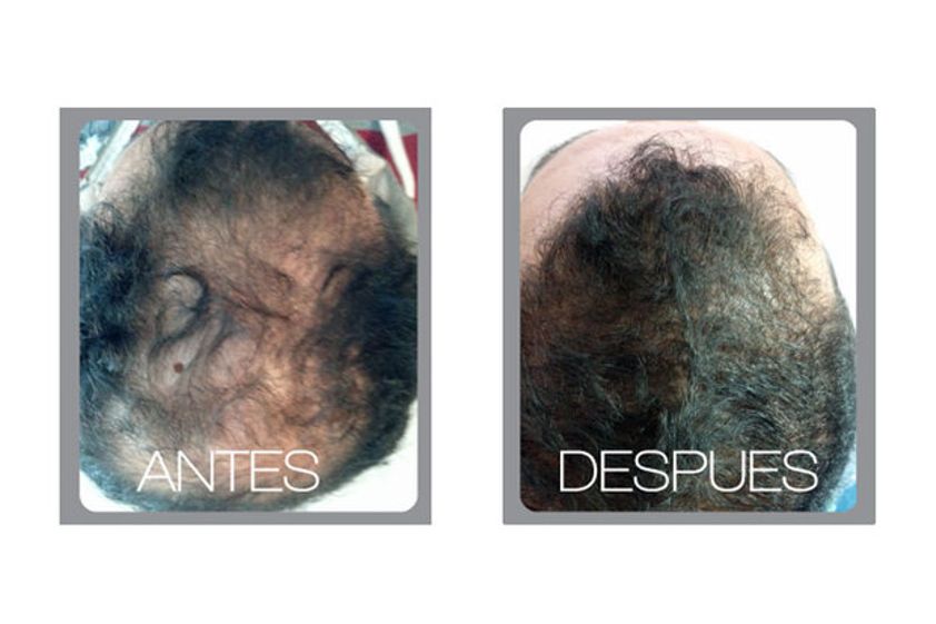 Implantes de cabello antes y después - 511211