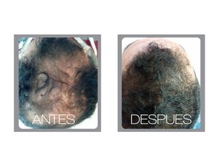 Implantes de cabello