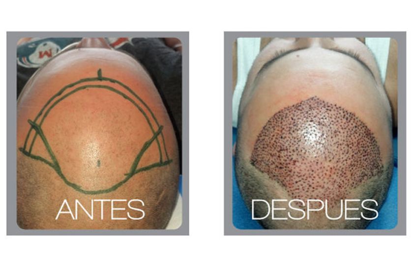 Implantes de cabello antes y después - 511212