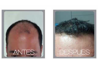 Implantes de cabello