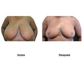 Mamoplastia reductora y correctora
