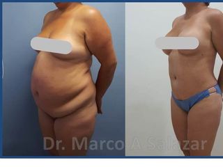 Abdominoplastia y Liposucción