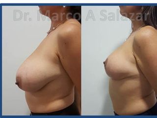 Mamoplastia de Reduccion PRE y POP