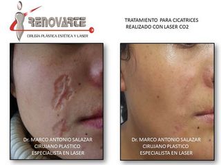 tratamiento laser para cicatriz