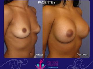 Mamoplastia de aumento