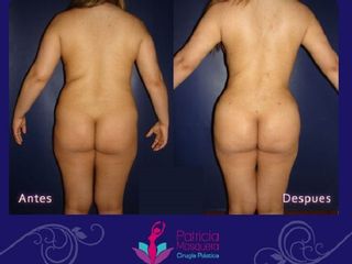 Gluteoplastia