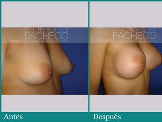 Mamoplastia de aumento