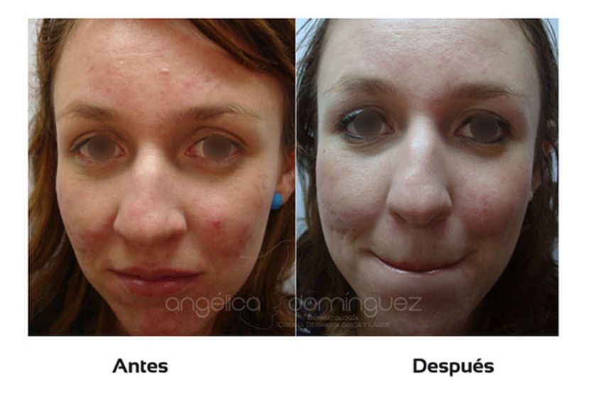 Acné antes y después - 509978