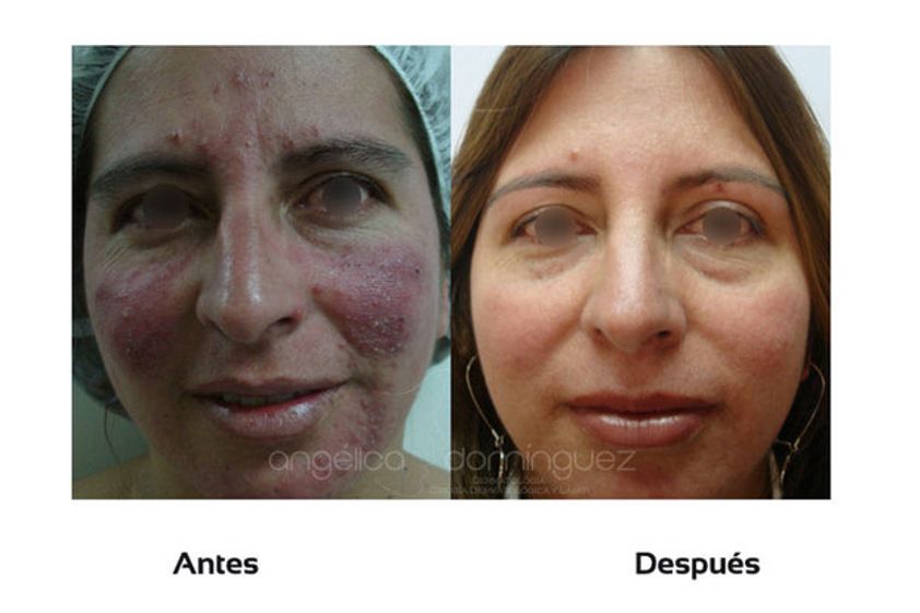 Acné antes y después - 509979