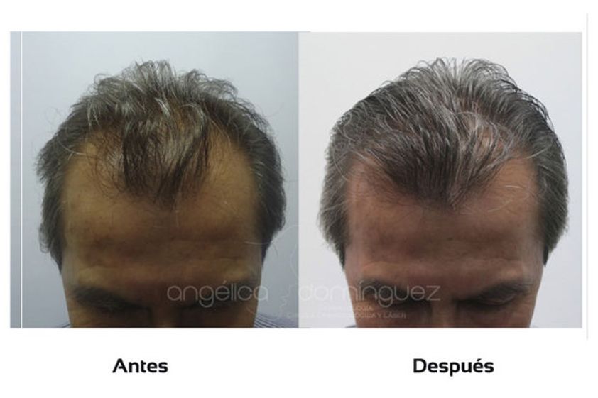 Alopecia antes y después - 509982