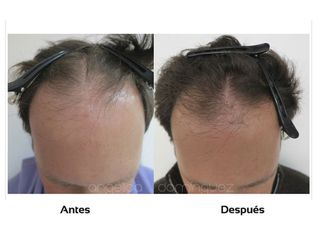 Tratamiento contra la alopecia