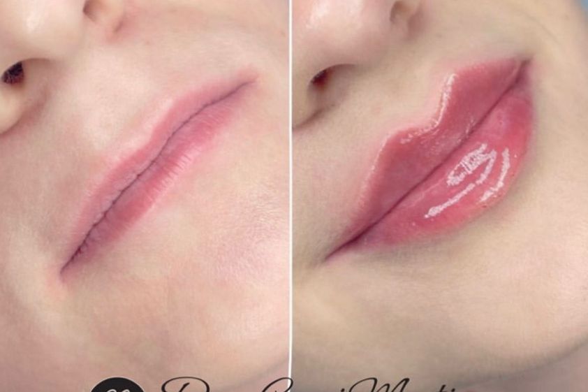 Aumento de labios antes y después - 848551