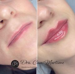 Aumento de labios - Dra. Camila Martínez