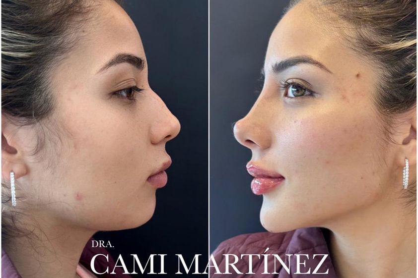 Rejuvenecimiento facial antes y después - 848552