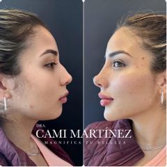 Full Face + Rinomodelación + Aumento de Labios - Dra. Camila Martínez