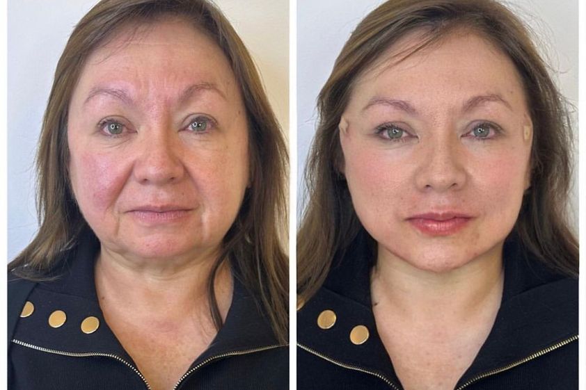 Rejuvenecimiento facial antes y después - 848553