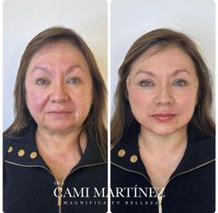 Rejuvenecimiento Facial - Dra. Camila Martínez