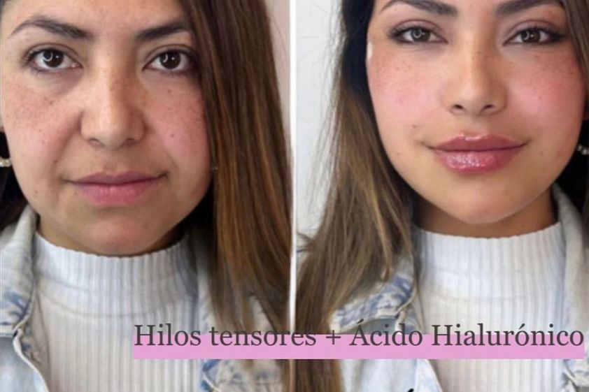 Ácido hialurónico antes y después - 848556
