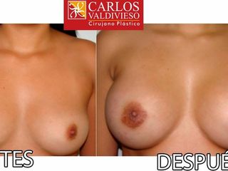 Mamoplastia de aumento