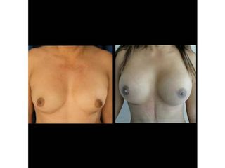 Mamoplastia de Aumento  