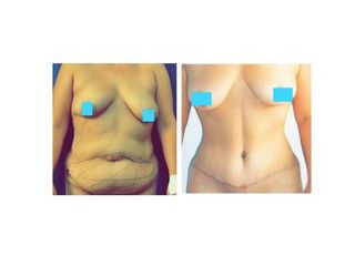 Abdominoplastía