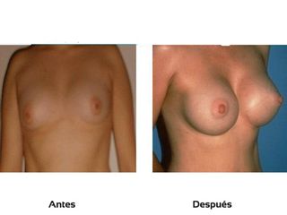 Mamoplastia de aumento