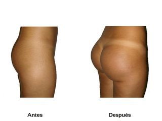 Gluteoplastia