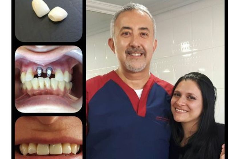 Implantes dentales antes y después - 687103