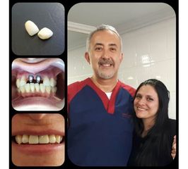 Implantes Dentales