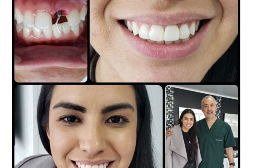 Implantes dentales antes y después - 687105