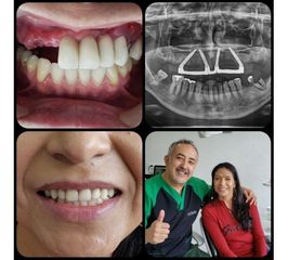 Implantes Dentales