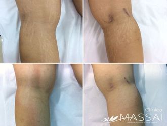 Eliminar estrías antes y después - 638621