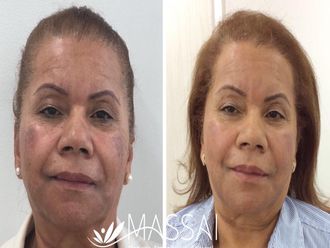 Peeling - 638626
