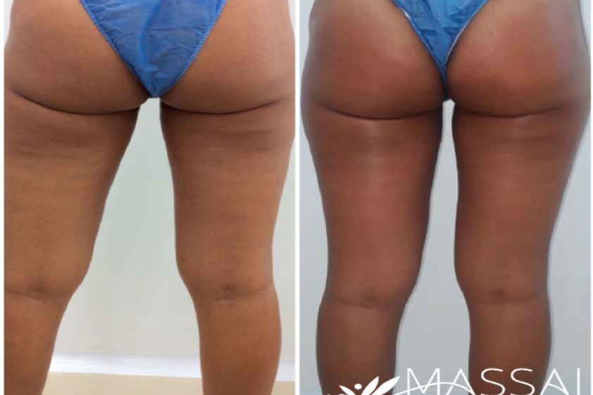 Mesoterapia antes y después - 638627