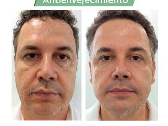 Rejuvenecimiento facial - 737546