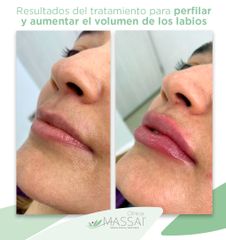 Aumento de labios - Massai Clínica