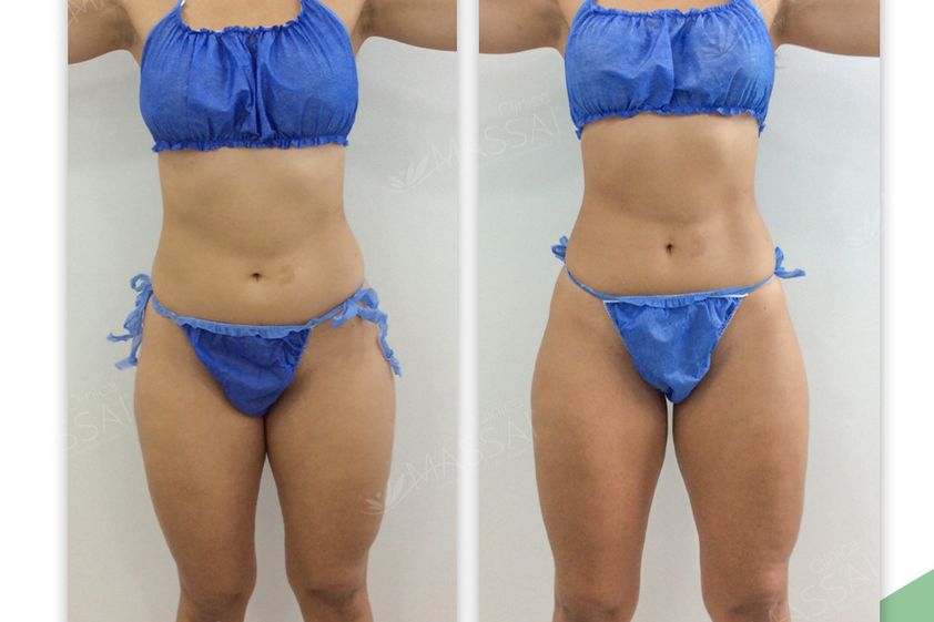 Mesoterapia antes y después - 843517