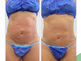 Mesoterapia antes y después - 843519