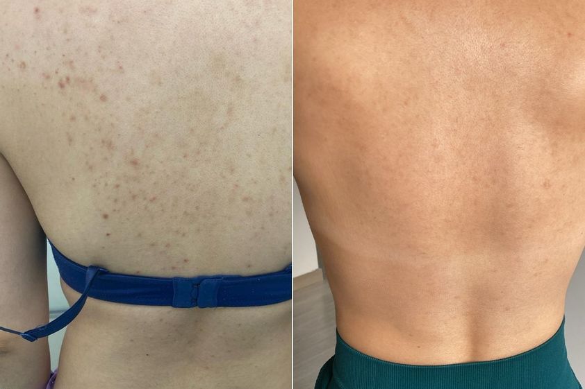 Peeling antes y después - 864295