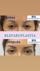 Blefaroplastia - Dr. David Yanguas Bodensiek