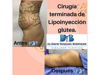 Gluteoplastia - Dr. David Yanguas Bodensiek