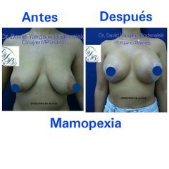 Mamoplastia de reducción - Dr. David Yanguas Bodensiek