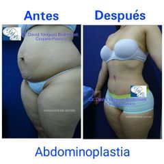 Abdominoplastia - Dr. David Yanguas Bodensiek