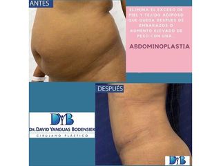 Abdominoplastia - Dr. David Yanguas Bodensiek